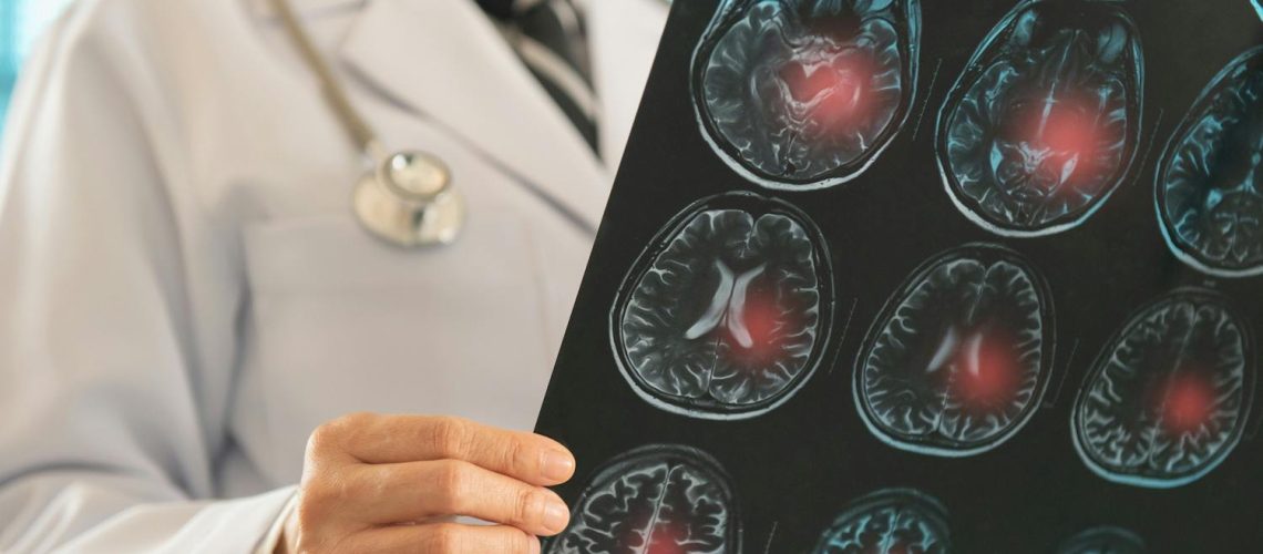 Ischémie : de quoi parle-t-on ?